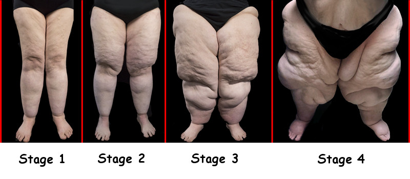 Four Stages of Lipedema