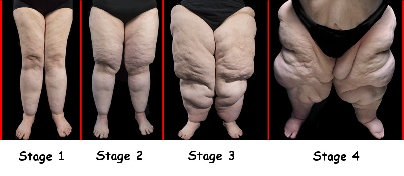 Lipedema Pinch Test: Do I Have Lipedema?