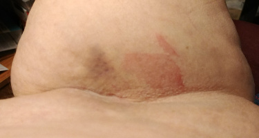 Bruise and rash from IV needle