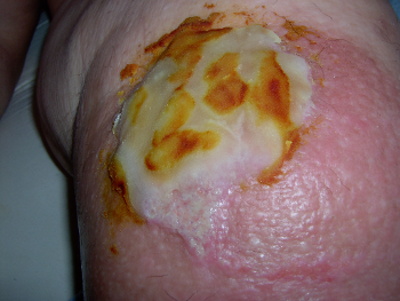 Cellulitis Ulcer