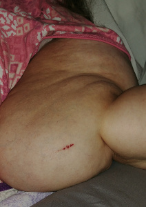 Cut in arm with Lipo-Lymphedema