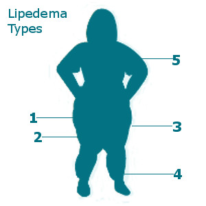 Lipedema Types