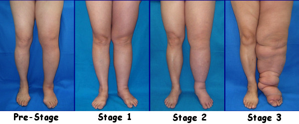 Stages of Lymphedema