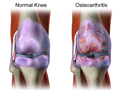 Regular and Osteoarthritis knees