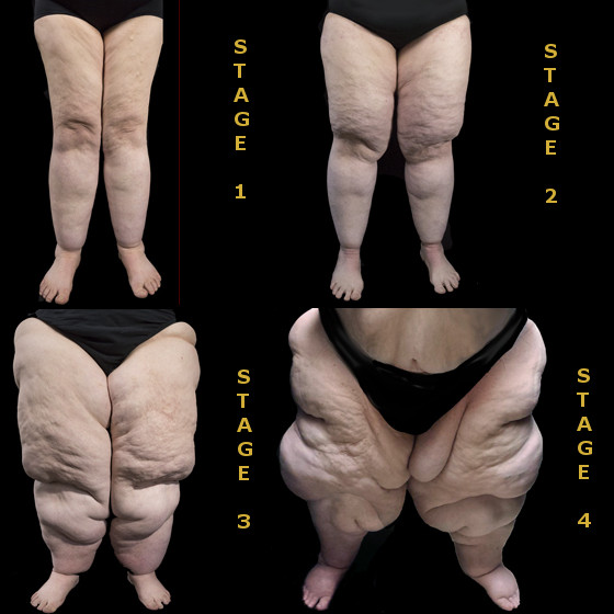 Four Stages of Lipedema