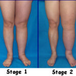 Four stages of Lymphedema