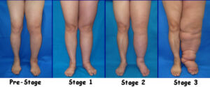 Four stages of Lymphedema