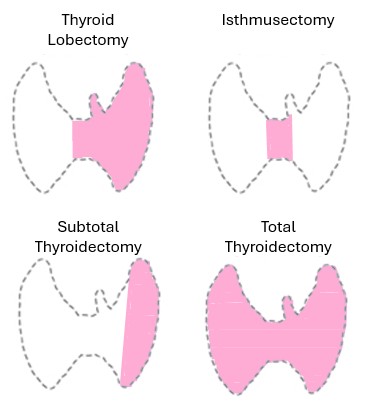 Thyroid Surgery Types